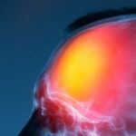 Medical illustration of a traumatic brain injury highlighting damaged brain tissue, representing head trauma after an accident and the need for legal representation.