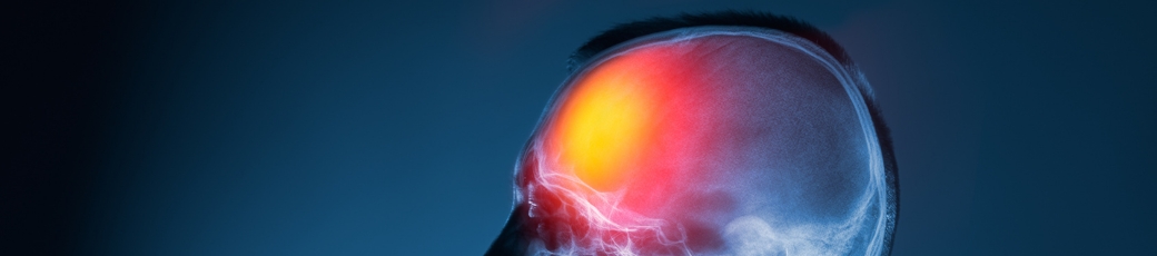 Medical illustration of a traumatic brain injury highlighting damaged brain tissue, representing head trauma after an accident and the need for legal representation.